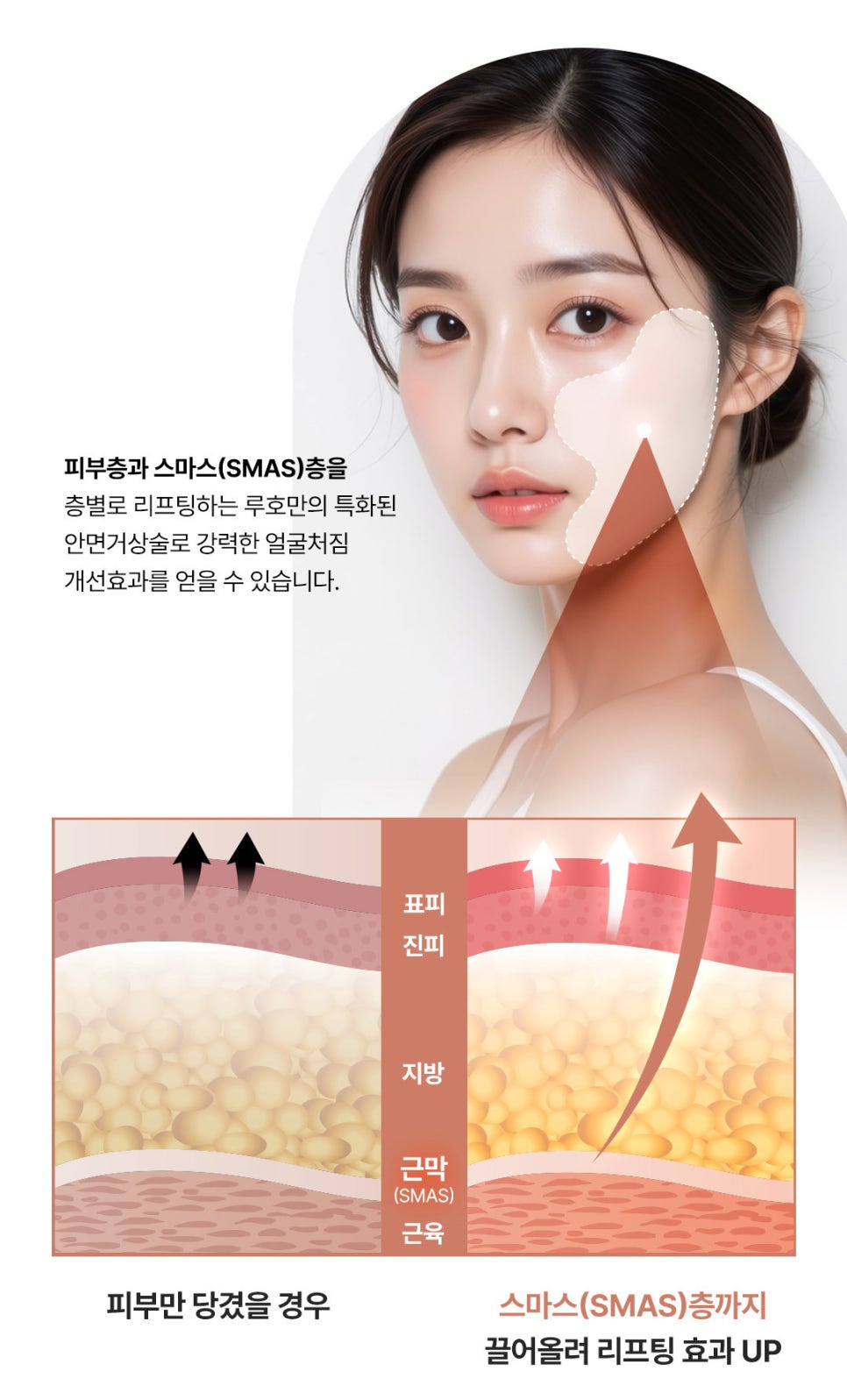 안면거상 전 알아야 할 3가지, 효과부터 흉터까지 관련 이미지 2