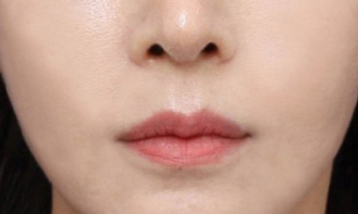 늘어진 하안면을 개선한 신사역 실리프팅 전후 관련 이미지 5