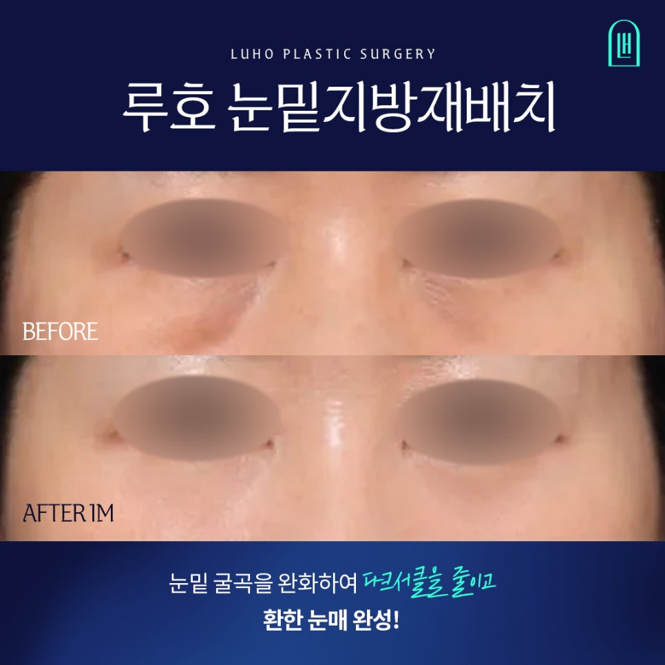 A Review of Lower Eyelid Fat Repositioning at Sinsa Station That Helped Soften Noticeable Dark Circles image 1