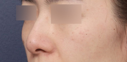 A Rhinoplasty Review for the Nasal Tip at Sinsa Station That Changed a Blurry Impression image 3