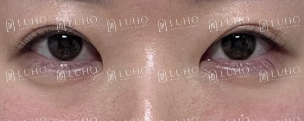 How Revision Eye Surgery Changed Uneven Eyes and a Sleepy-Looking Eye Shape image 2