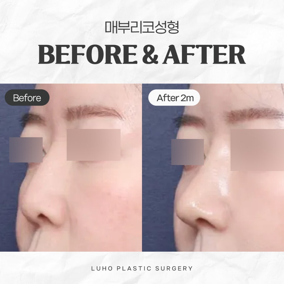 Rhinoplasty for a Hump Nose at Sinsa Station: A Review of the Change to a Smooth Line image 1