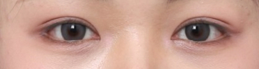 답답한 눈매 개선, 신사역 뒤밑트임 후기 관련 이미지 5