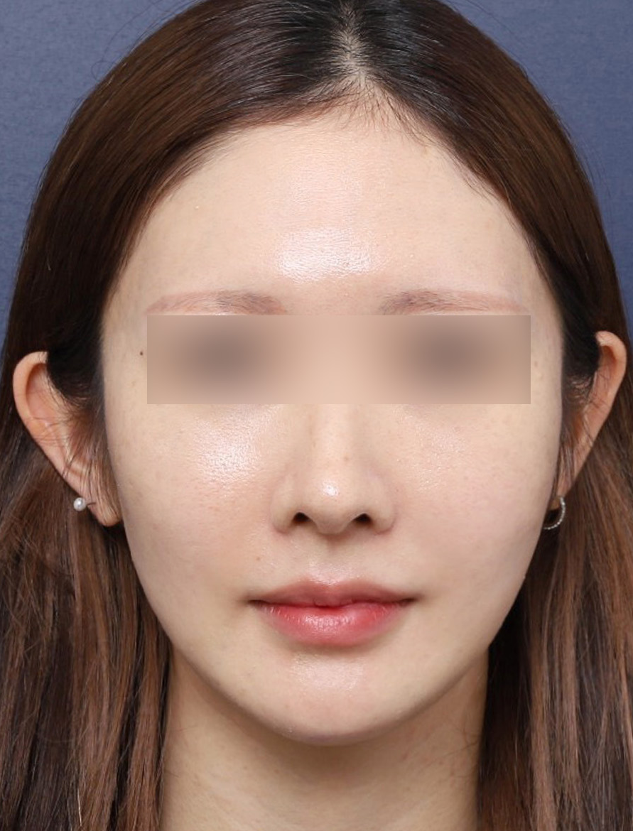 Review of Resolving Cheek Sagging with Thread Lifting Near Sinsa Station image 5