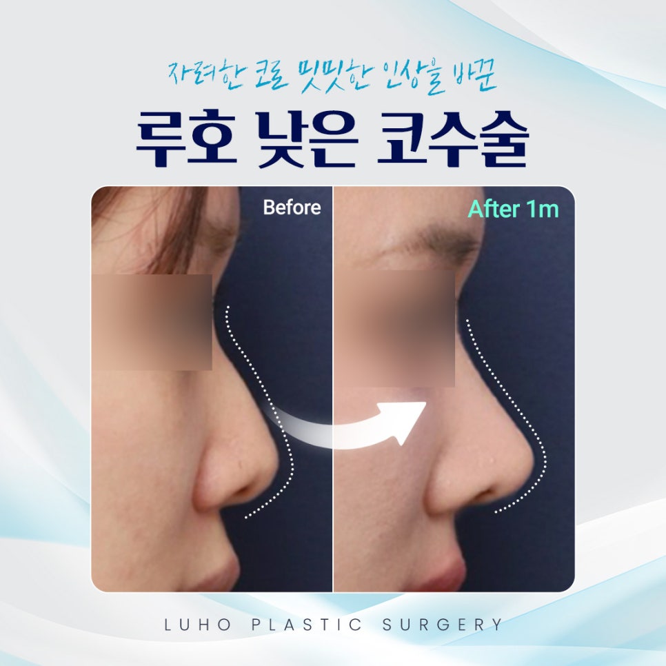밋밋한 인상을 자려한 코로 바꿔놓은 신사역 낮은코수술 사례 관련 이미지 1