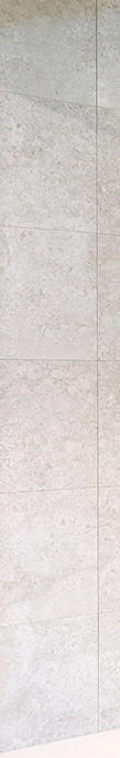 What Are the Key Points Before and After Eyelid Correction at Apgujeong Station? image 8