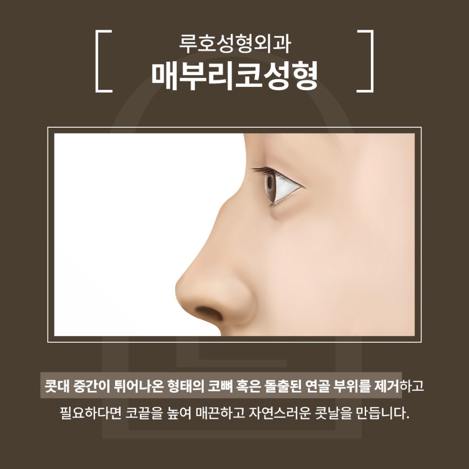 A Real Sinsa Station Rhinoplasty Case That Created a Harmonious Face image 3