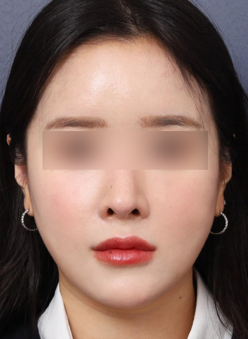 Sinsa Station Midface Thread Lifting for a More Youthful Appearance image 5