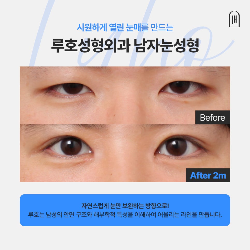 Before and After Male Eye Surgery at Sinsa Station That Created a Positive Impression image 1