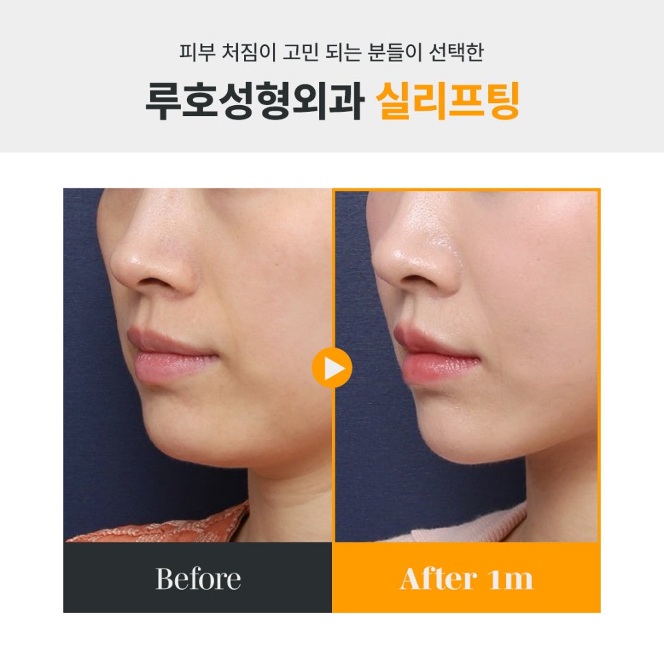흩어진 균형과 라인을 동시에 잡은 신사역 성형외과 실리프팅 전후 관련 이미지 6