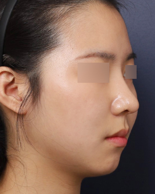 Bulbous Nose Surgery Before and After at Sinsa Station: Achieving the Desired Contour image 5