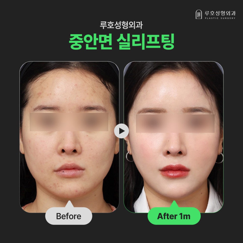 Sinsa Station Midface Thread Lifting for a More Youthful Appearance image 1