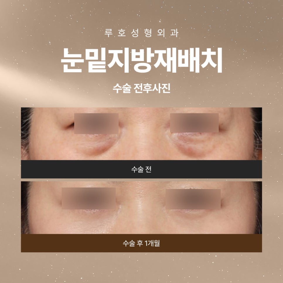 신사역눈밑지방재배치로 밝고 환해진 인상 관련 이미지 1