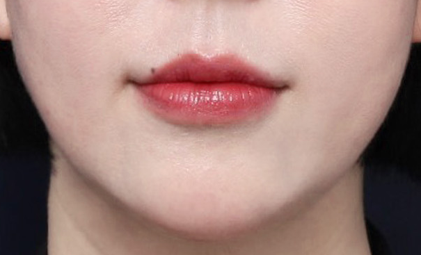 Refined Lower Face Line with Thread Lifting at Sinsa Station image 5