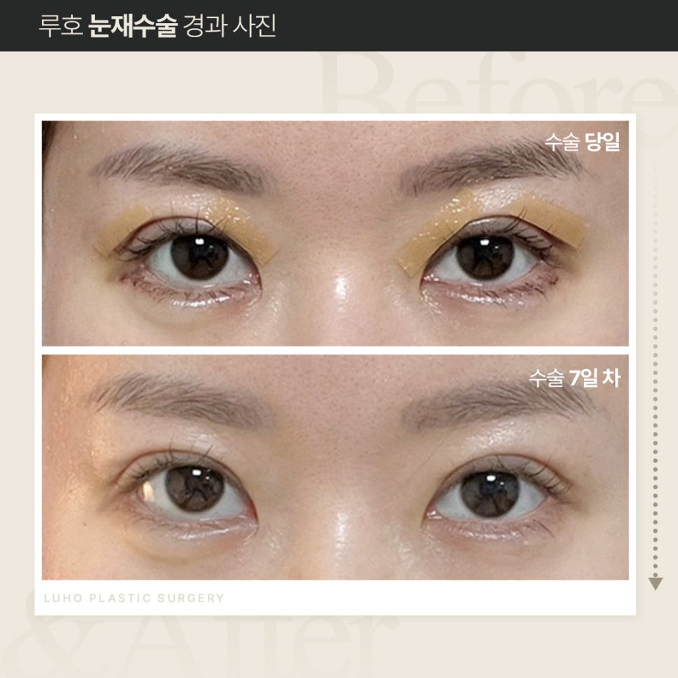 루호성형외과 눈재수술, 회복 얼마나 걸릴까? 관련 이미지 2