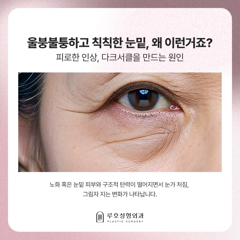 Dark Shadows Under the Eyes, a Different Look After Under-Eye Fat Repositioning Surgery at Sinsa Station image 2