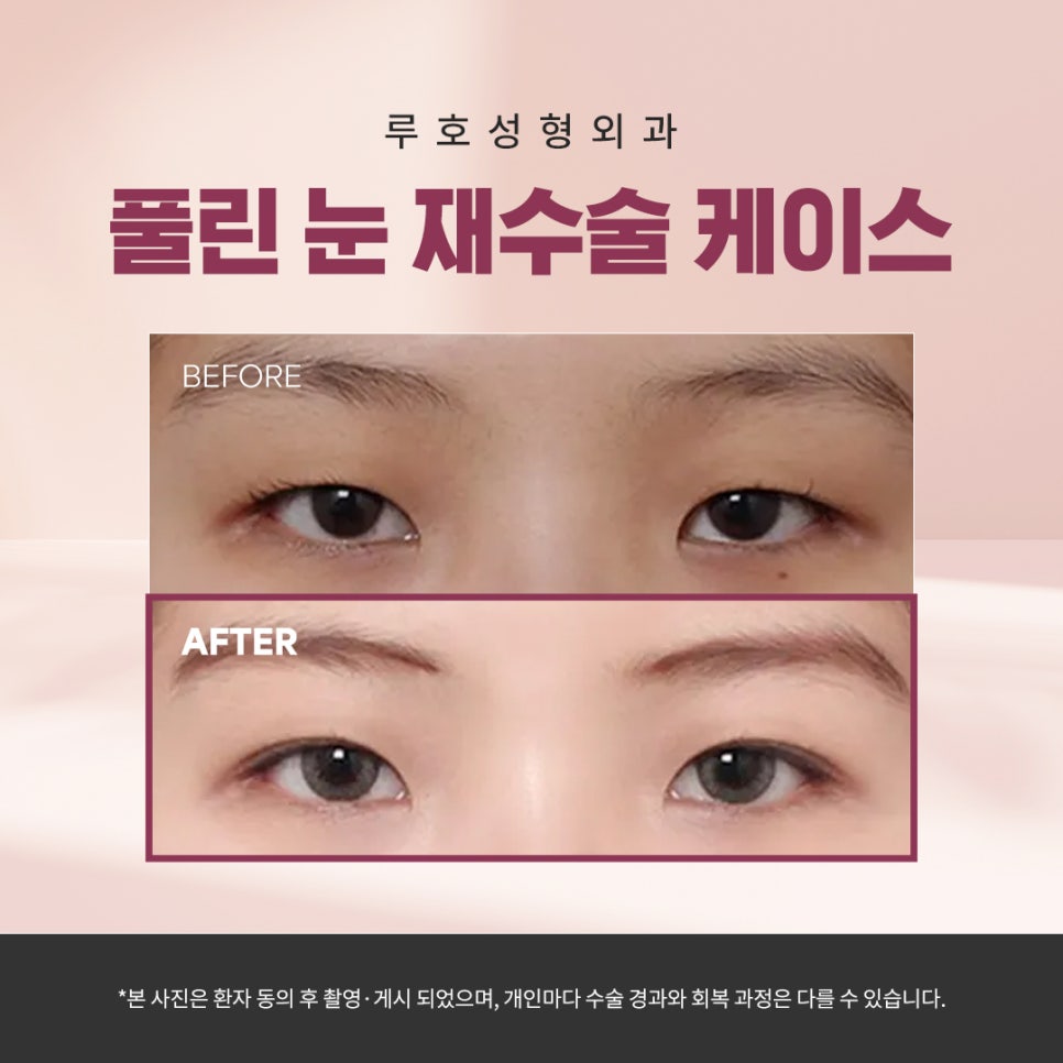 Sinnonhyeon Station Double Eyelid Revision Surgery for Faded Lines: Sharpening a Loose Line image 1