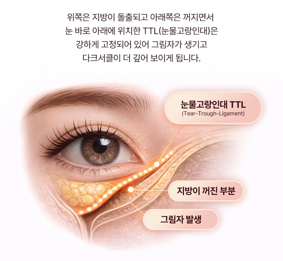 Effects of Male Under-Eye Fat Repositioning for a More Vibrant-Looking Eye Area image 2