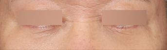 The Effects of Lower Blepharoplasty That Transformed Sagging Under-Eye Skin image 5