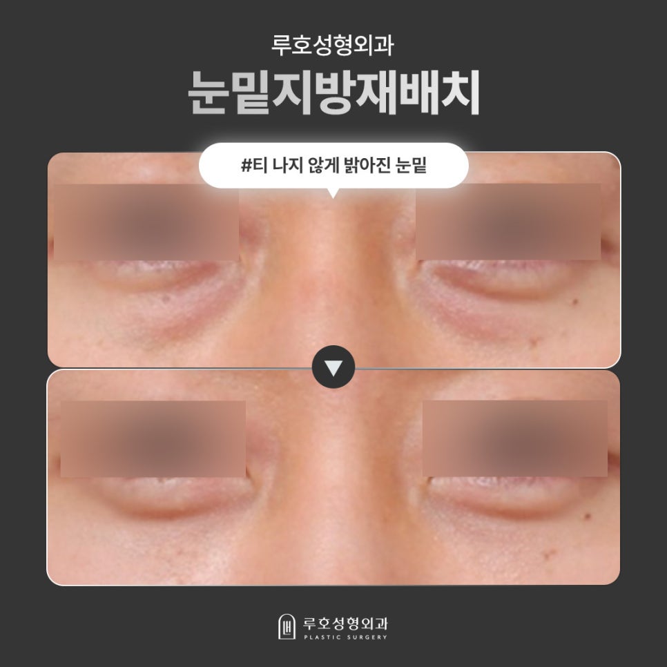 구조의 문제로 인한 다크서클, 환하게 바꾼 남성눈밑지후기 관련 이미지 1