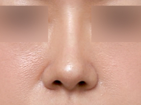 Before and After Nose Surgery Near Sinsa Station with a Refined Line Through Broad Nasal Bridge Correction image 5