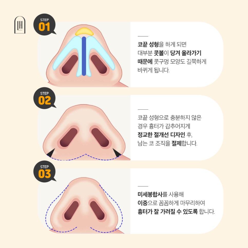 콧볼축소수술로 슬림하게! 관련 이미지 4
