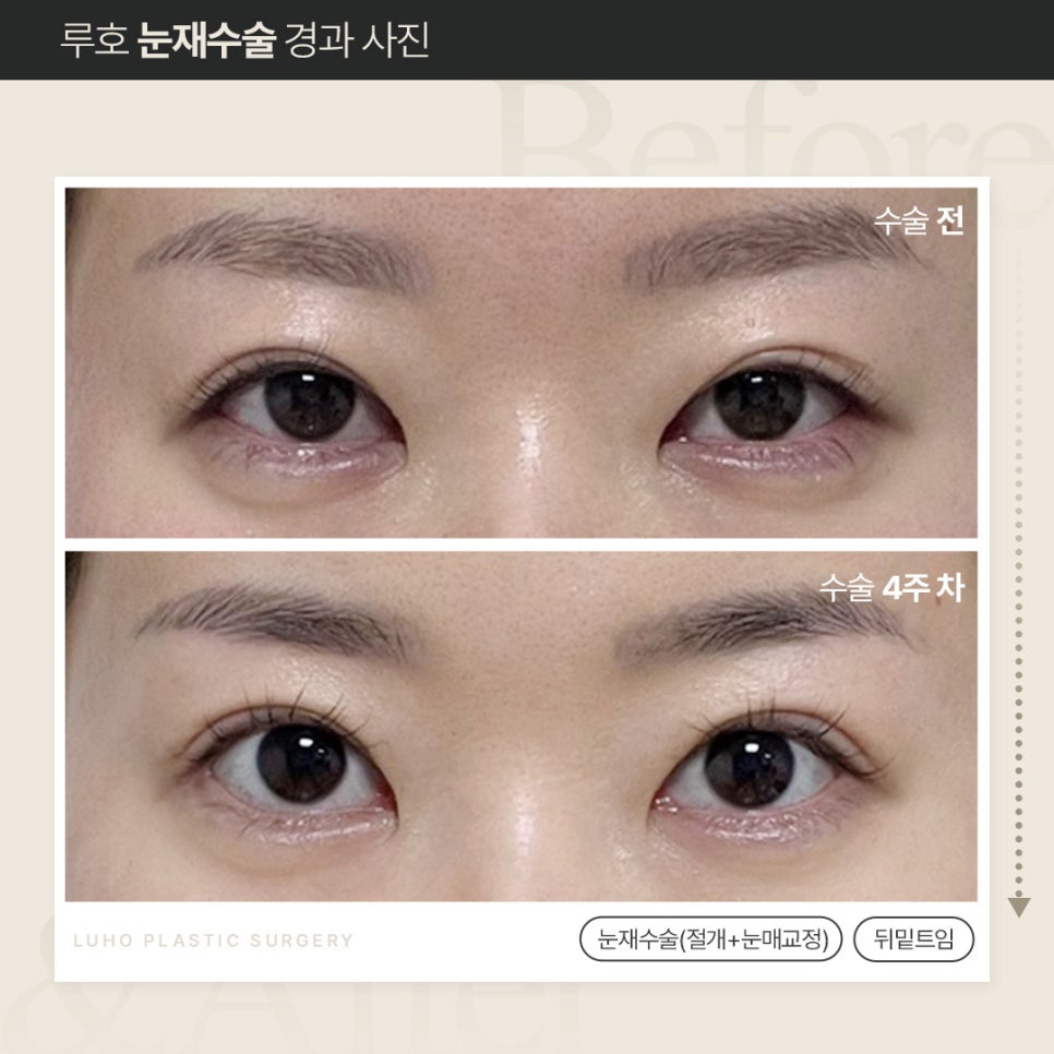 루호성형외과 눈재수술, 회복 얼마나 걸릴까? 관련 이미지 4