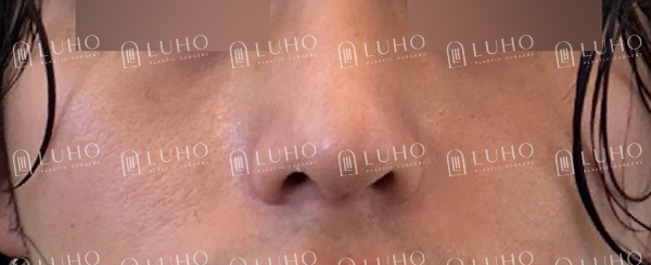 코 필러 후에도 고민이 남은 코라인 개선한 남자 코재수술 관련 이미지 7