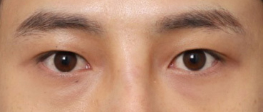 자연스러운 눈매 변화가 돋보이는 남자눈성형 후기 관련 이미지 5