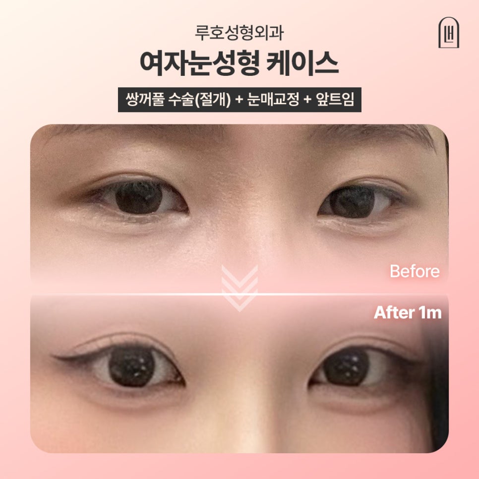 첫인상을 바꾼 눈매 변화, 신사역 여자눈성형 사례 관련 이미지 1