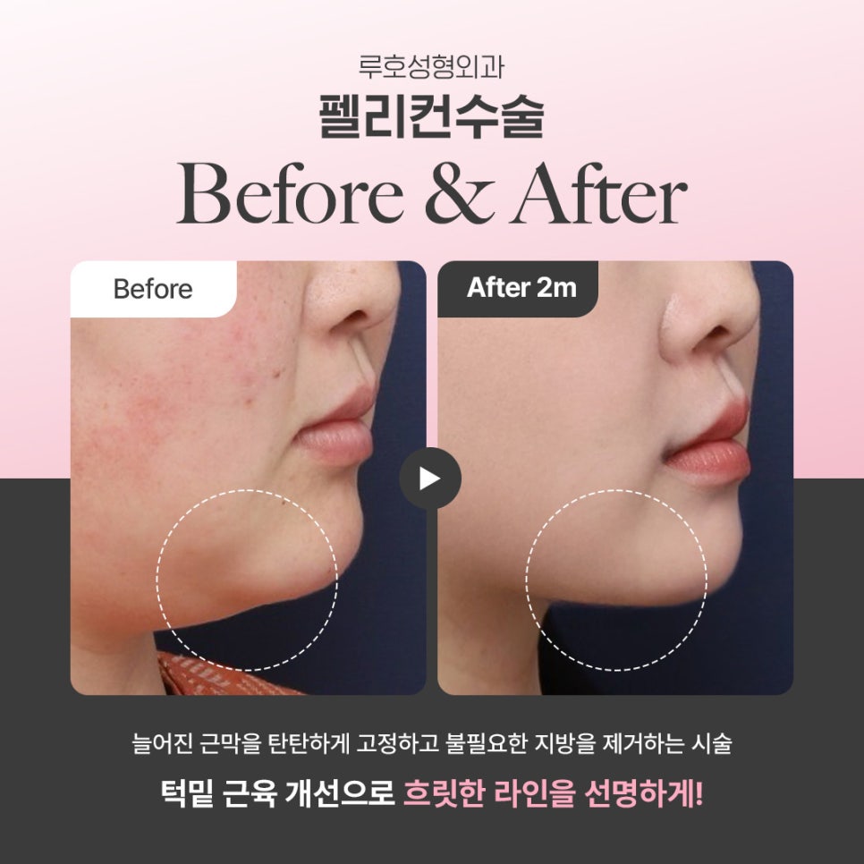 The Effect of Double-Chin Surgery in Creating a V-Line from a Blurred Jawline image 1