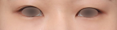 Dark Shadows Under the Eyes, a Different Look After Under-Eye Fat Repositioning Surgery at Sinsa Station image 5