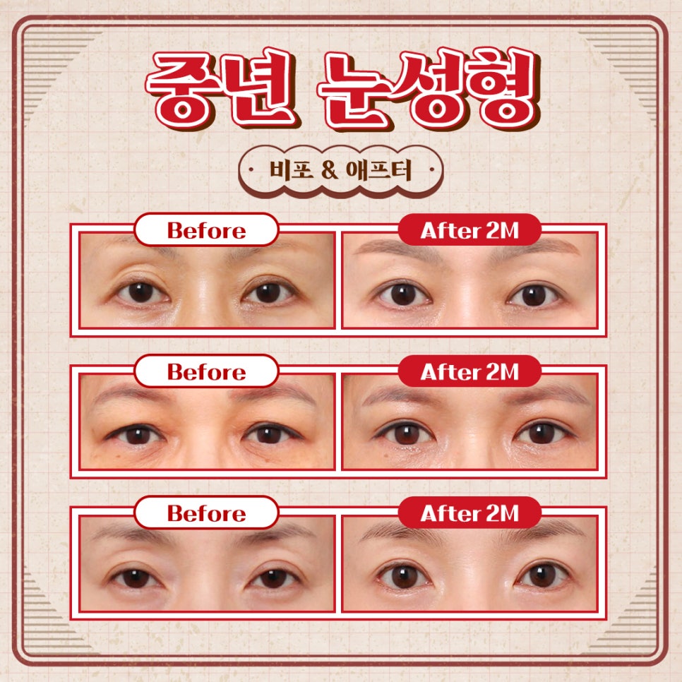 Middle-Aged Eye Surgery at Luho Plastic Surgery image 2