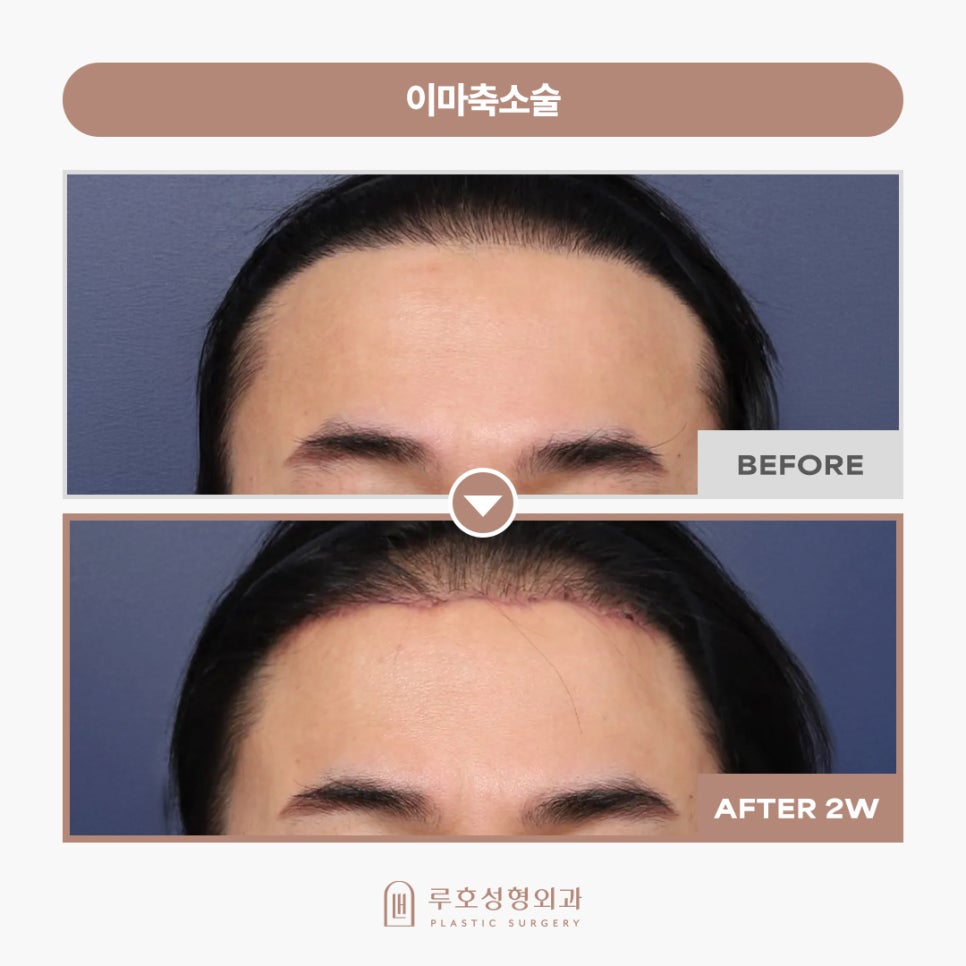 Sinsa Station Forehead Reduction Surgery: Real Before-and-After Review image 2