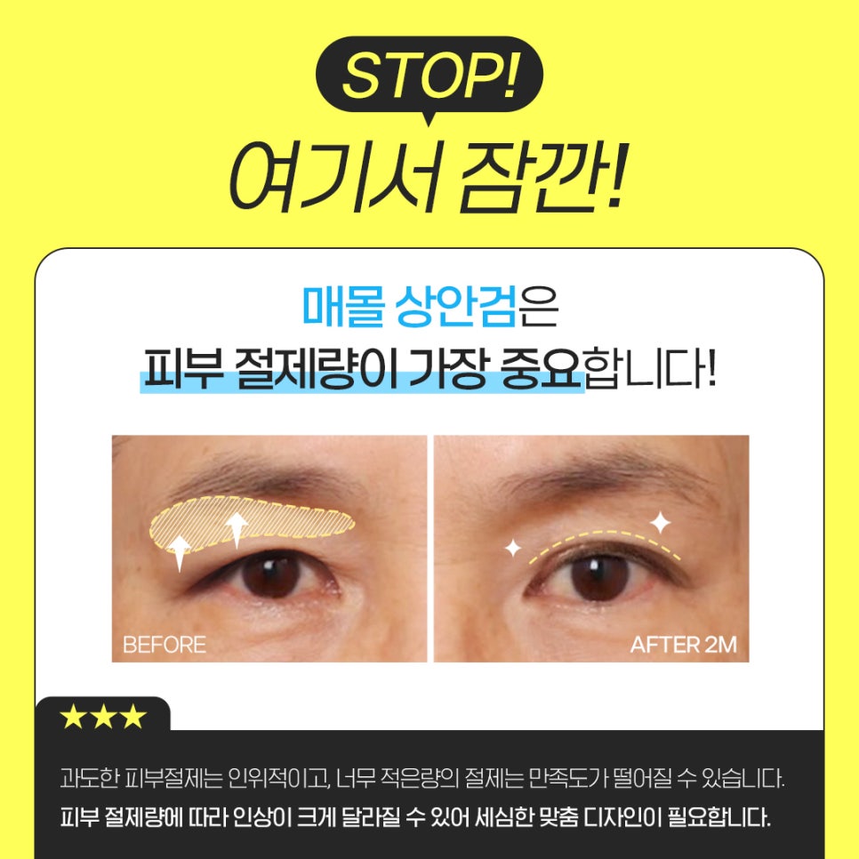 처진 눈꺼풀로 나이가 더 들어 보인다면? 관련 이미지 5