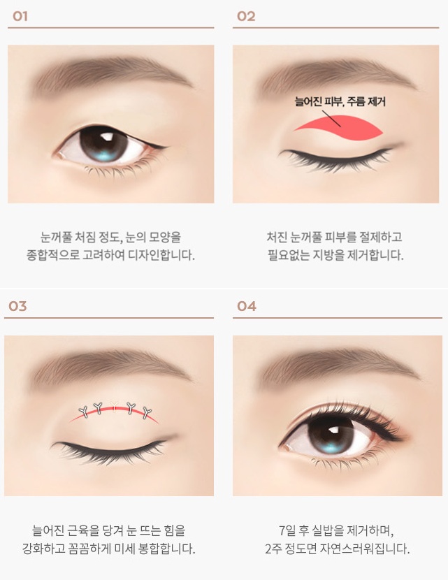A Case of Correcting Midlife Eyelid Sagging with Upper Blepharoplasty at Sinsa Station image 4