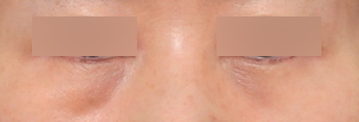 A Review of Lower Eyelid Fat Repositioning at Sinsa Station That Helped Soften Noticeable Dark Circles image 2