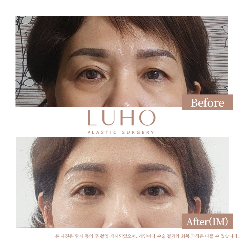 Sinsa Station Lower Eyelid Surgery Clinic: Real Before-and-After Comparison image 3