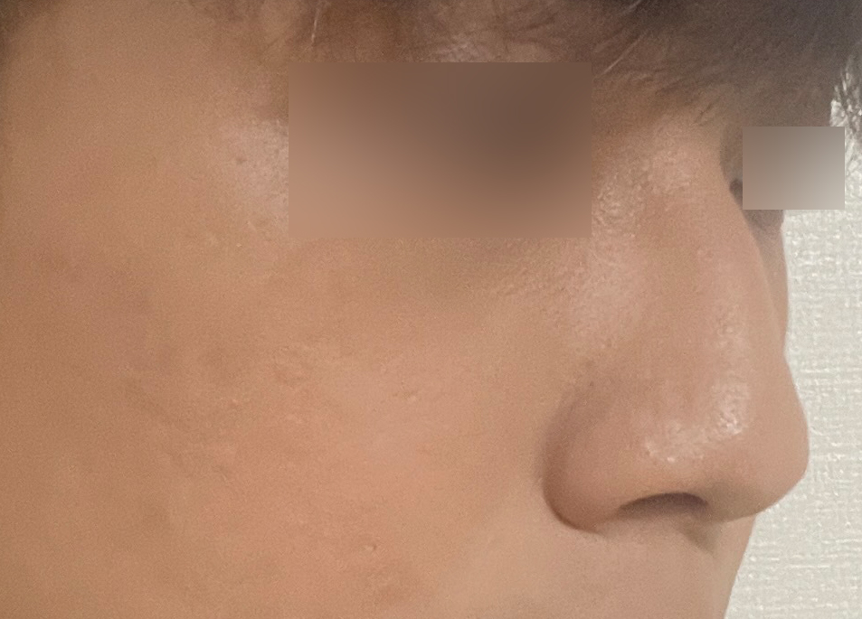 남다른 라인을 만들어 낸 신사역남자 코성형 전후 비교 관련 이미지 3