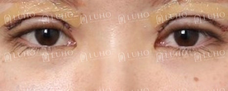 Improving an Eye Appearance That Had Lost Definition 8 Years After Buried-Suture Surgery image 5