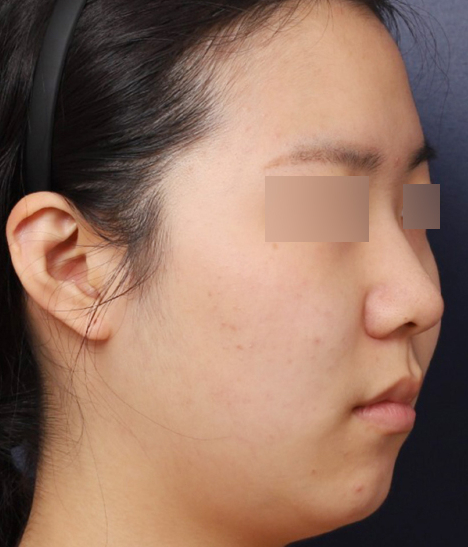 Bulbous Nose Surgery Before and After at Sinsa Station: Achieving the Desired Contour image 3