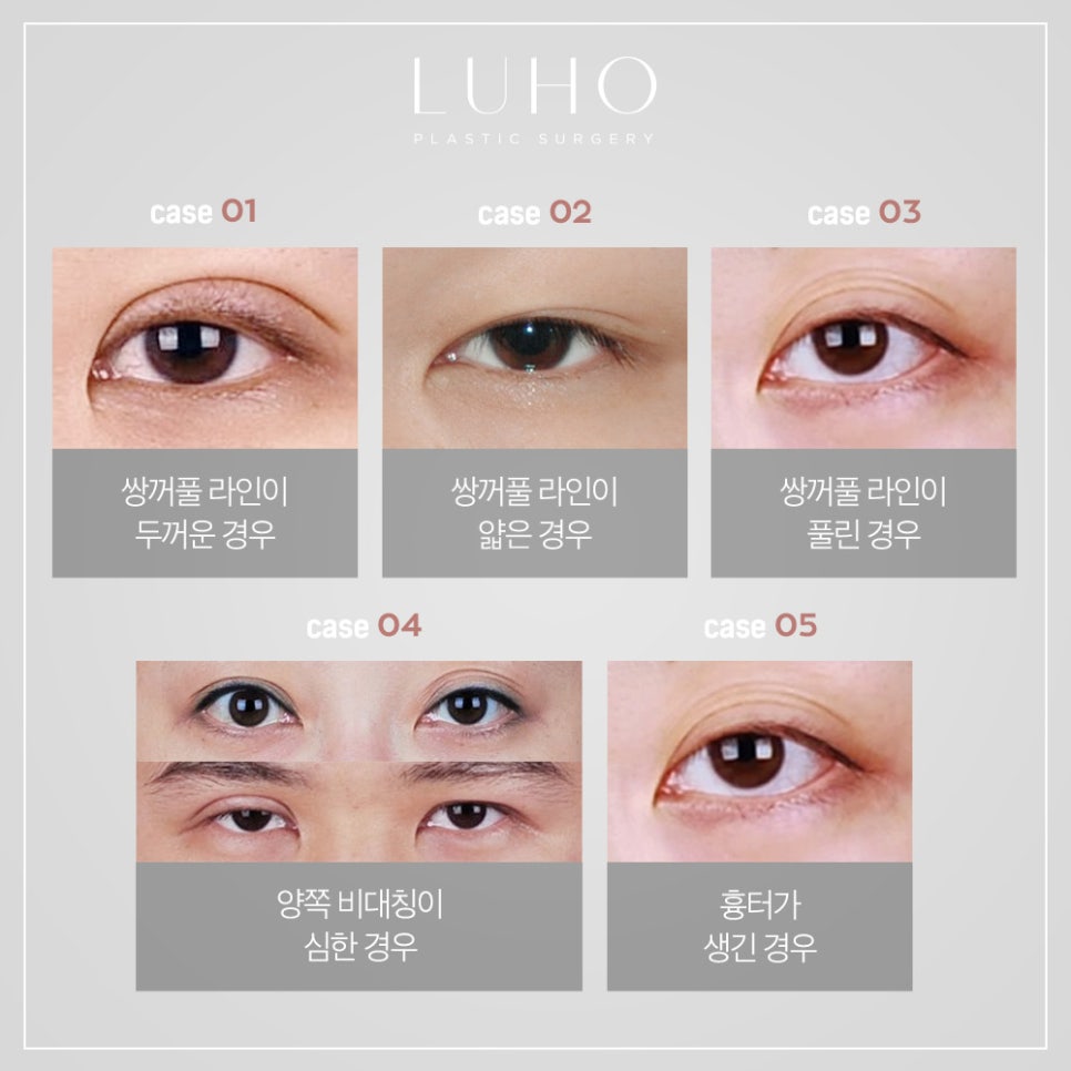 눈재수술 더 이상 후회하지 않도록 관련 이미지 2