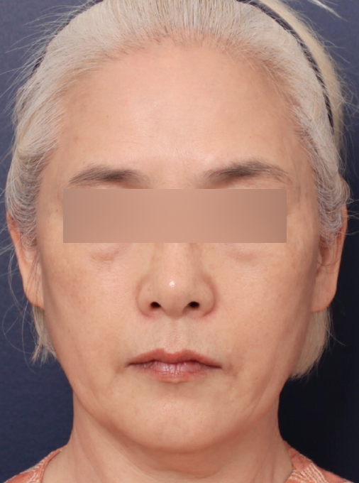 마리오네트 주름 해결한 신사역 안면거상술 효과 관련 이미지 2