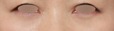 Sinsa Station Dark Circle Lower Eyelid Fat Repositioning: The Shadow Created by the Boundary Between the Under-Eye and Upper Cheek image 5