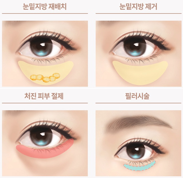 Looking Into Reviews and Precautions After Under-Eye Fat Repositioning image 3