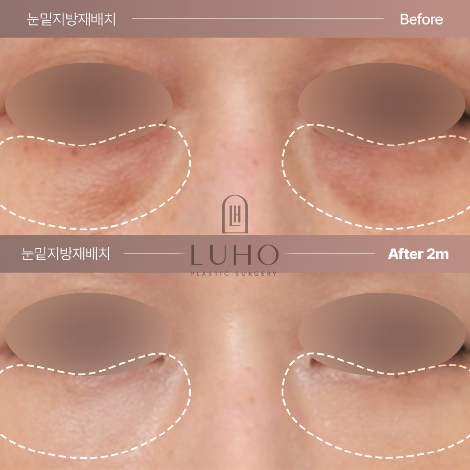 눈밑의 불룩함과 그림자를 완화해준 눈밑지방재배치 효과 관련 이미지 1