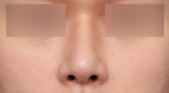 Before and After: Results That Changed with a Type-Specific Approach to Male Rhinoplasty at Sinsa Station image 4