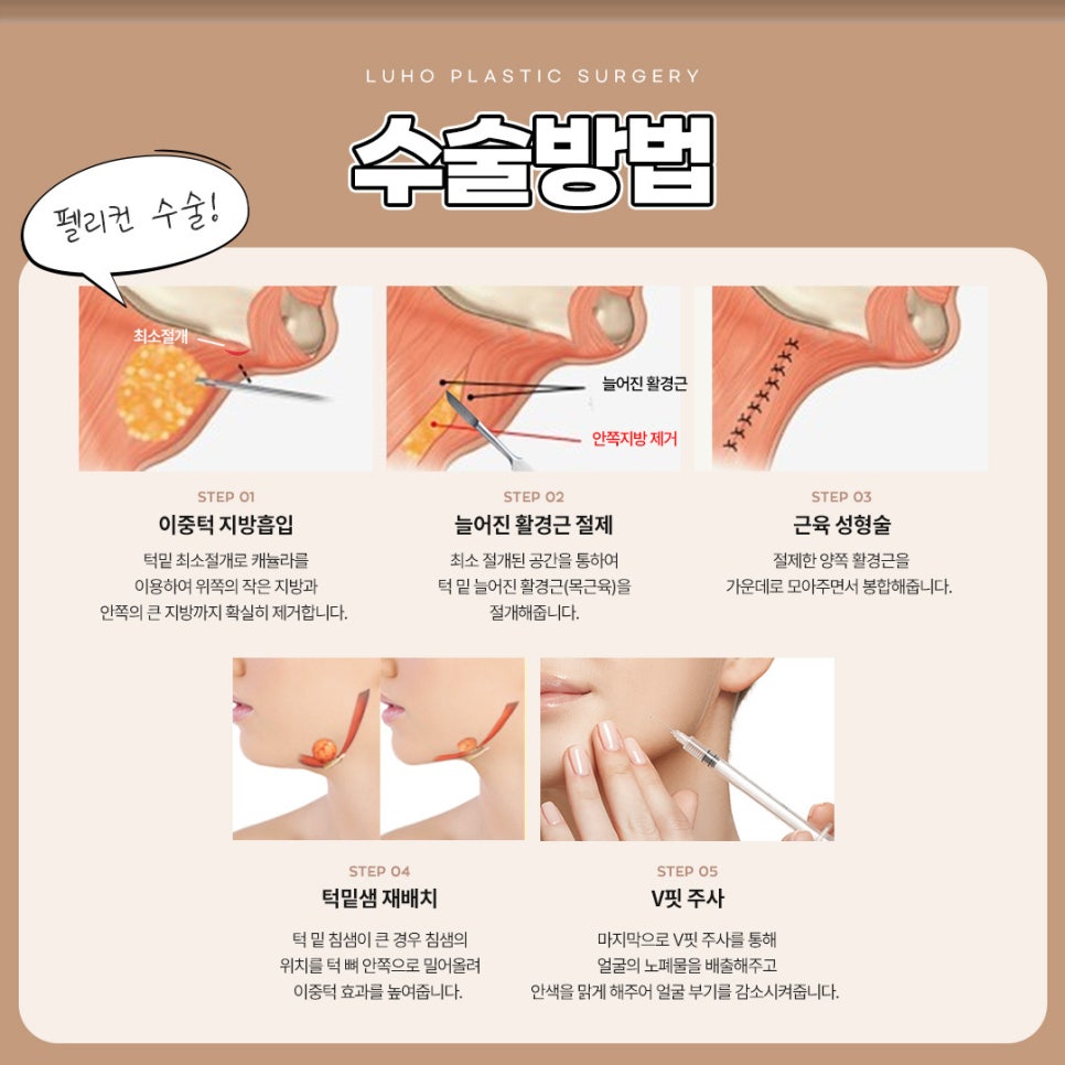 Luho Plastic Surgery Pelican Surgery to Regain a Hidden Jawline image 4