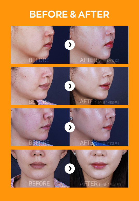 [Luoho Plastic Surgery] Slim V-Line Face Liposuction image 10