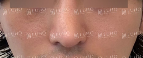 코 필러 후에도 고민이 남은 코라인 개선한 남자 코재수술 관련 이미지 11